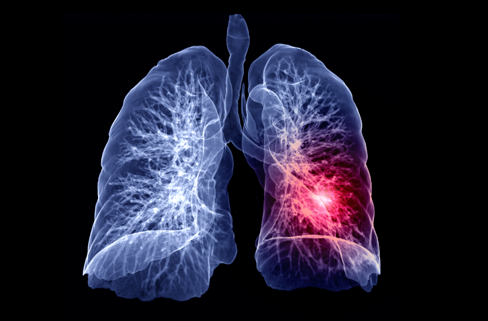 Patología Pleuropulmonar