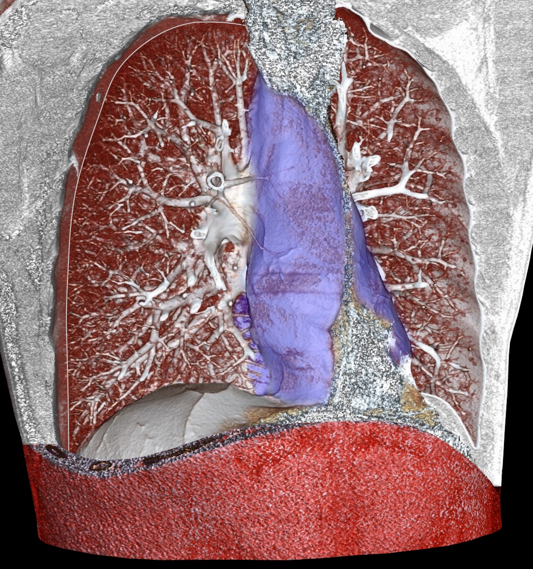 Patología de Mediastino